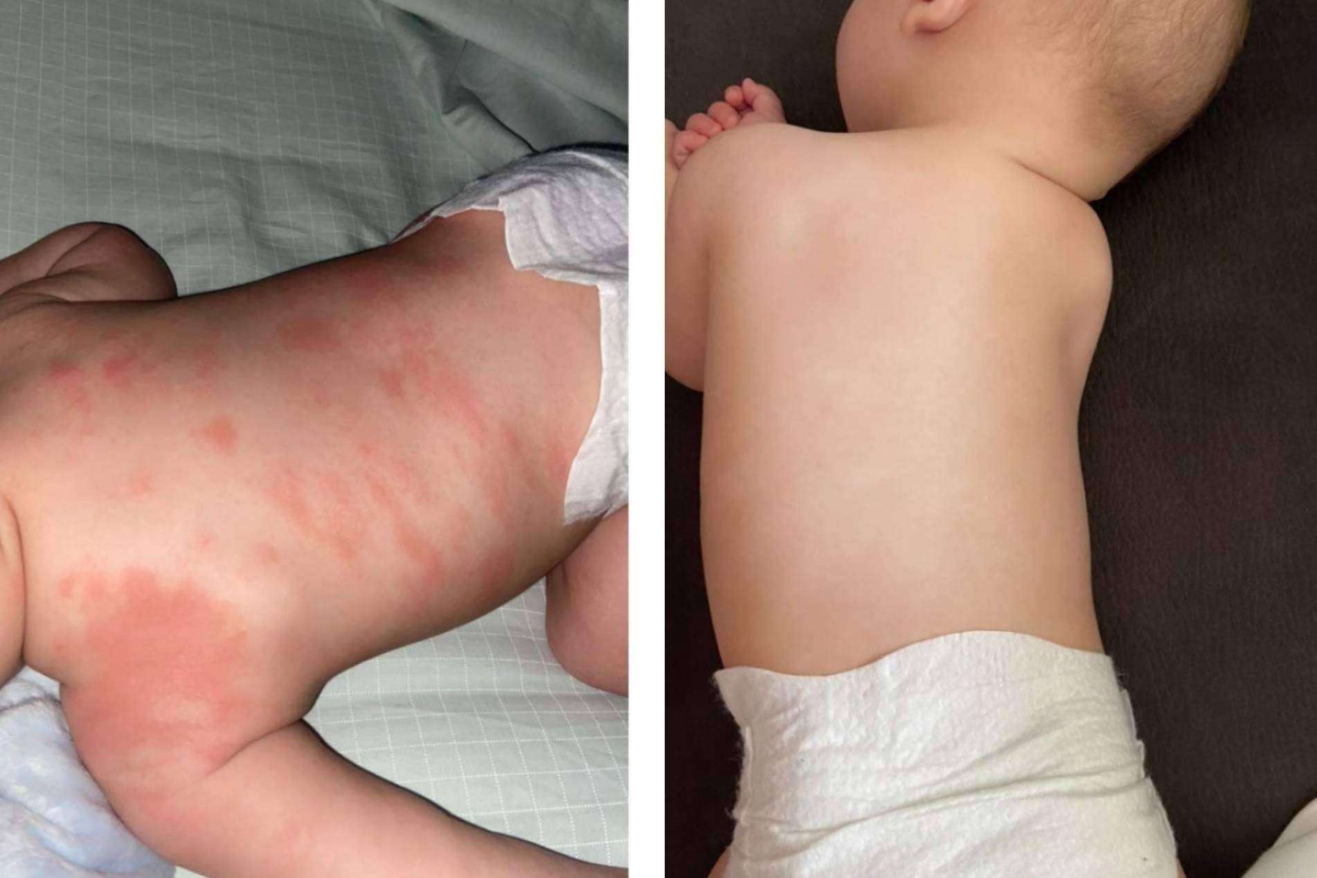 El antes y después de utilizar la crema hidratante de Green Cornerss en pieles atópicas