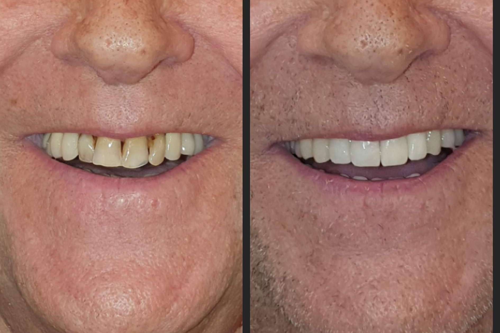 Dentinova ofrece alineación dentaria sin ortodoncia
