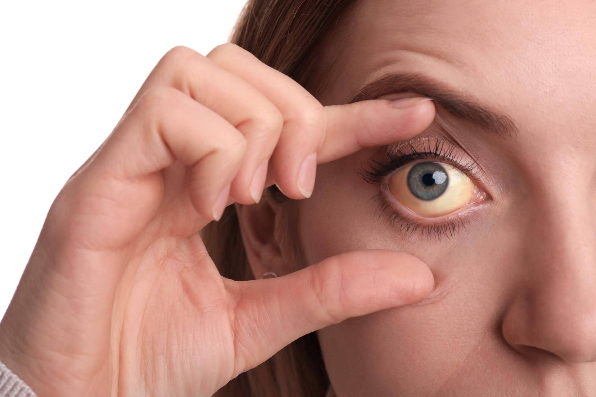 Las causas de los ojos amarillos y dónde tratarlos, explicado por el Instituto Oftalmológico Dexeus