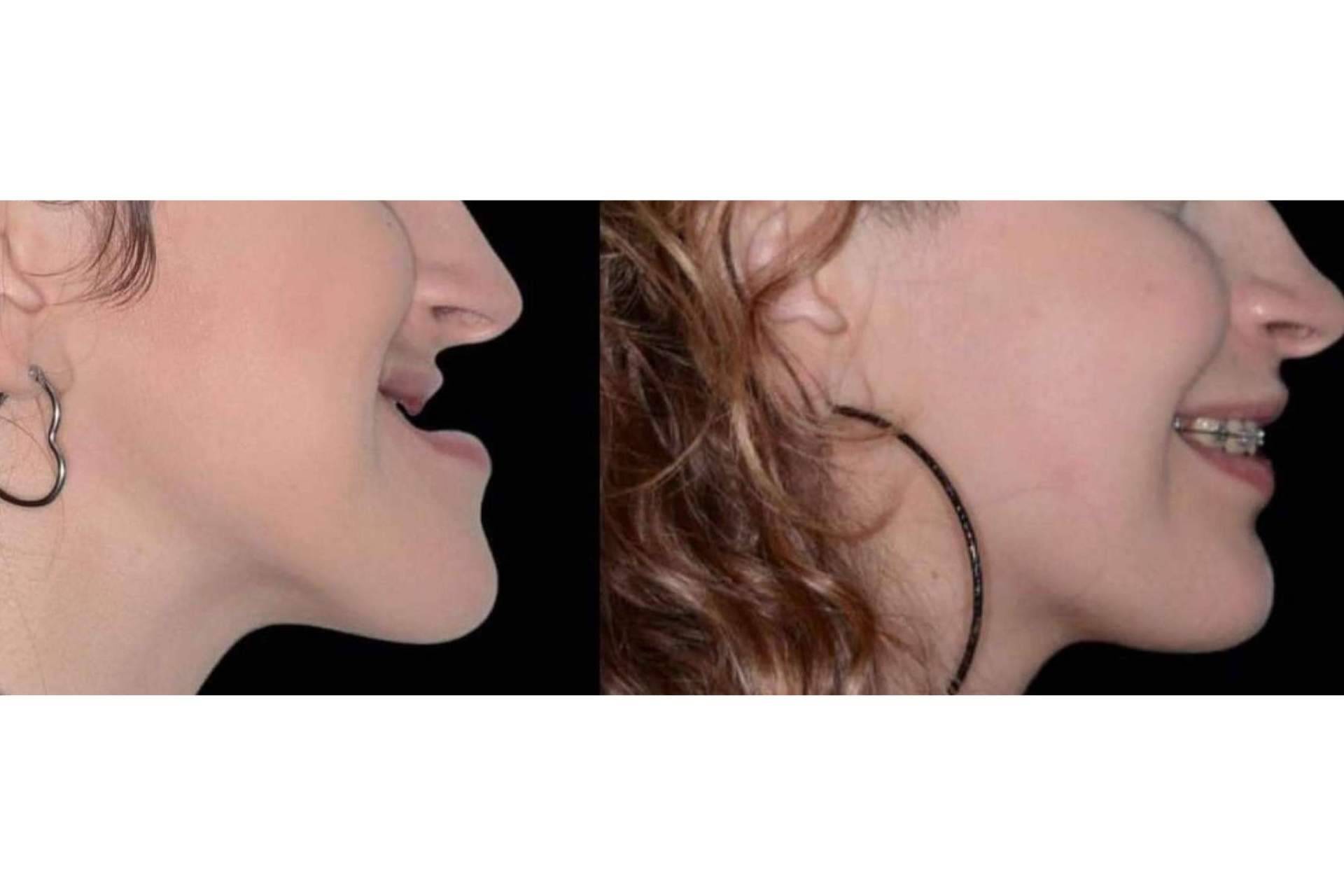 Clínica Calvo de Mora explica qué es la cirugía ortognática