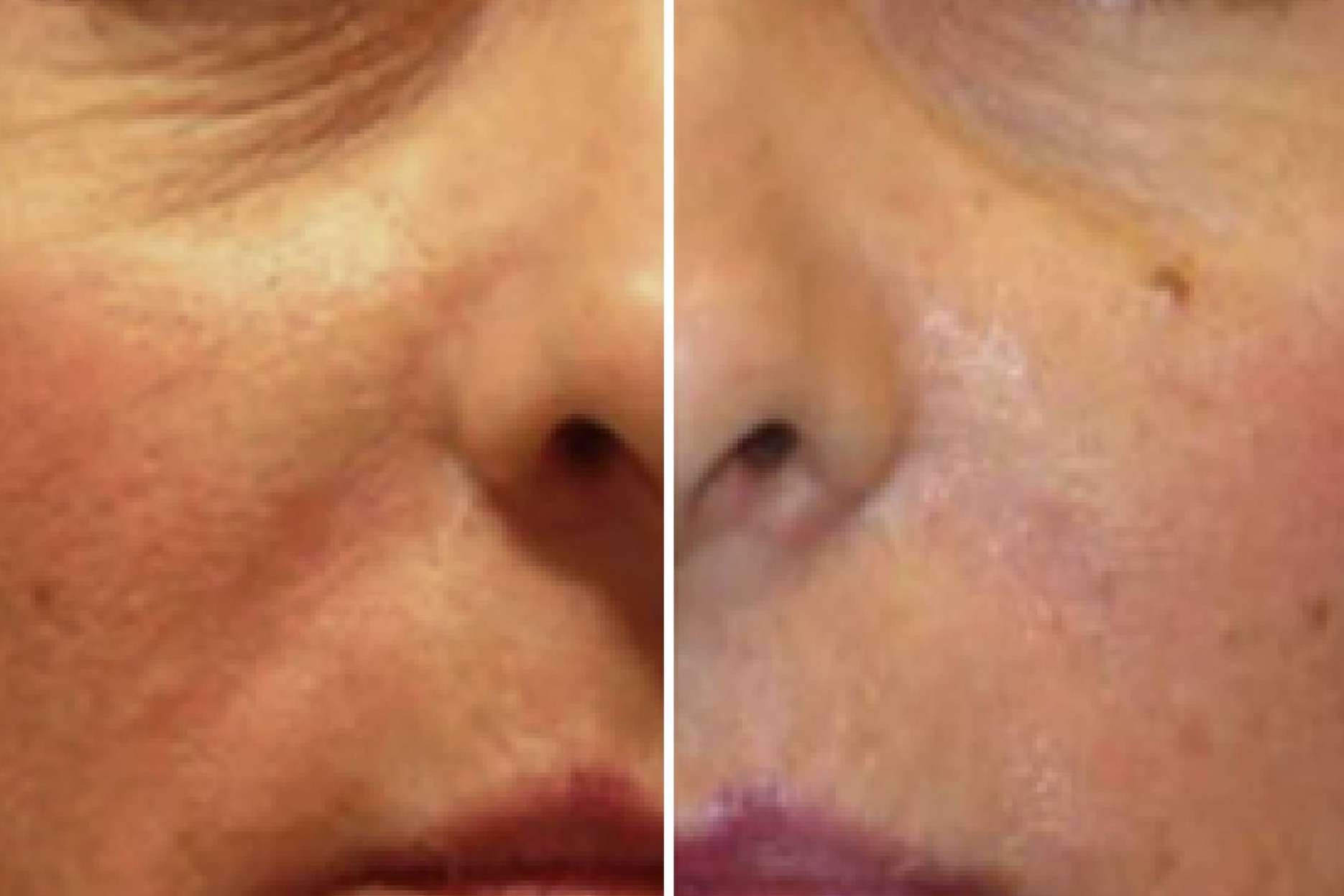 Acerca del Retargeting Facial RENOPHASE