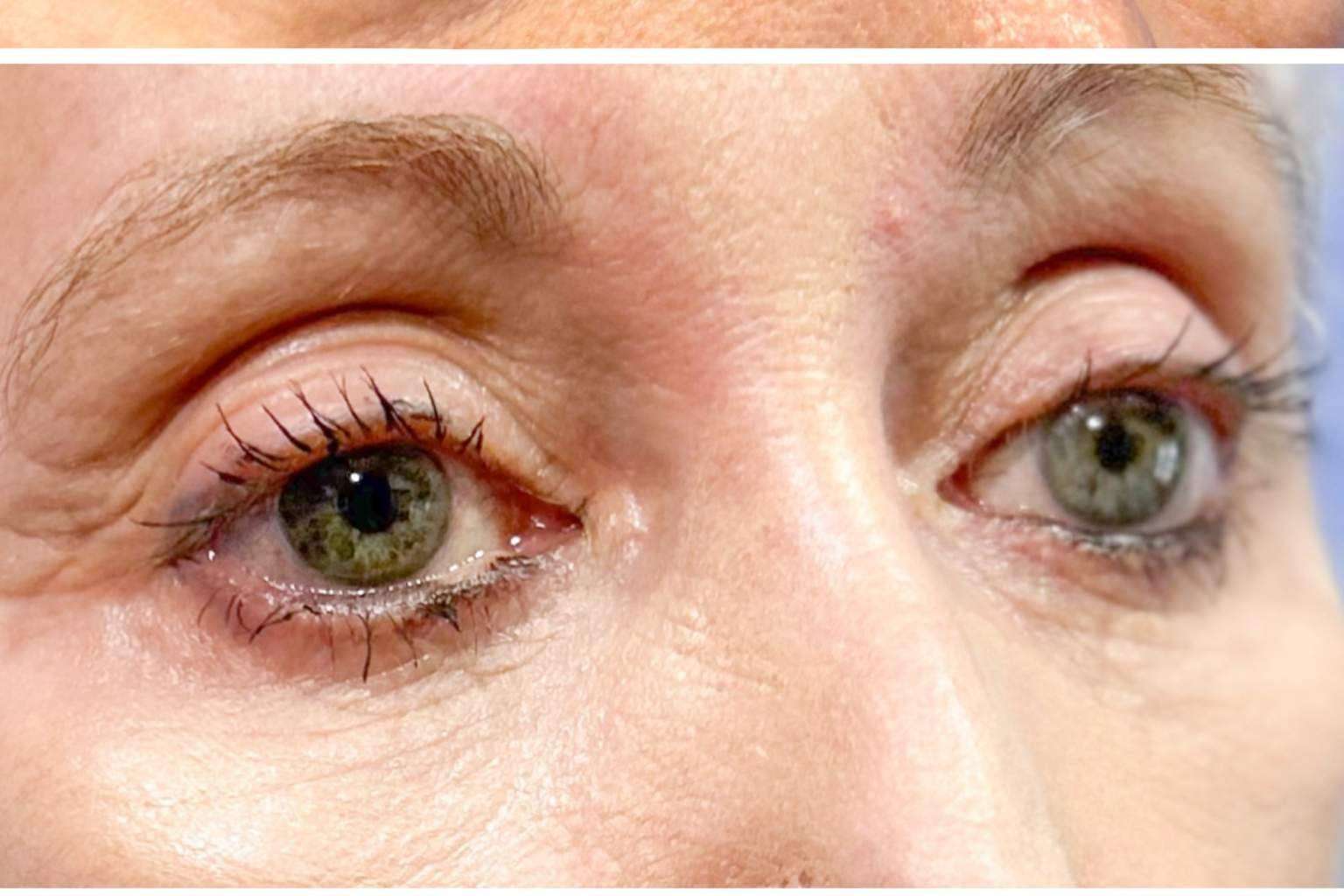 Rejuvenecimiento de la mirada con la ayuda de la cirugía estética