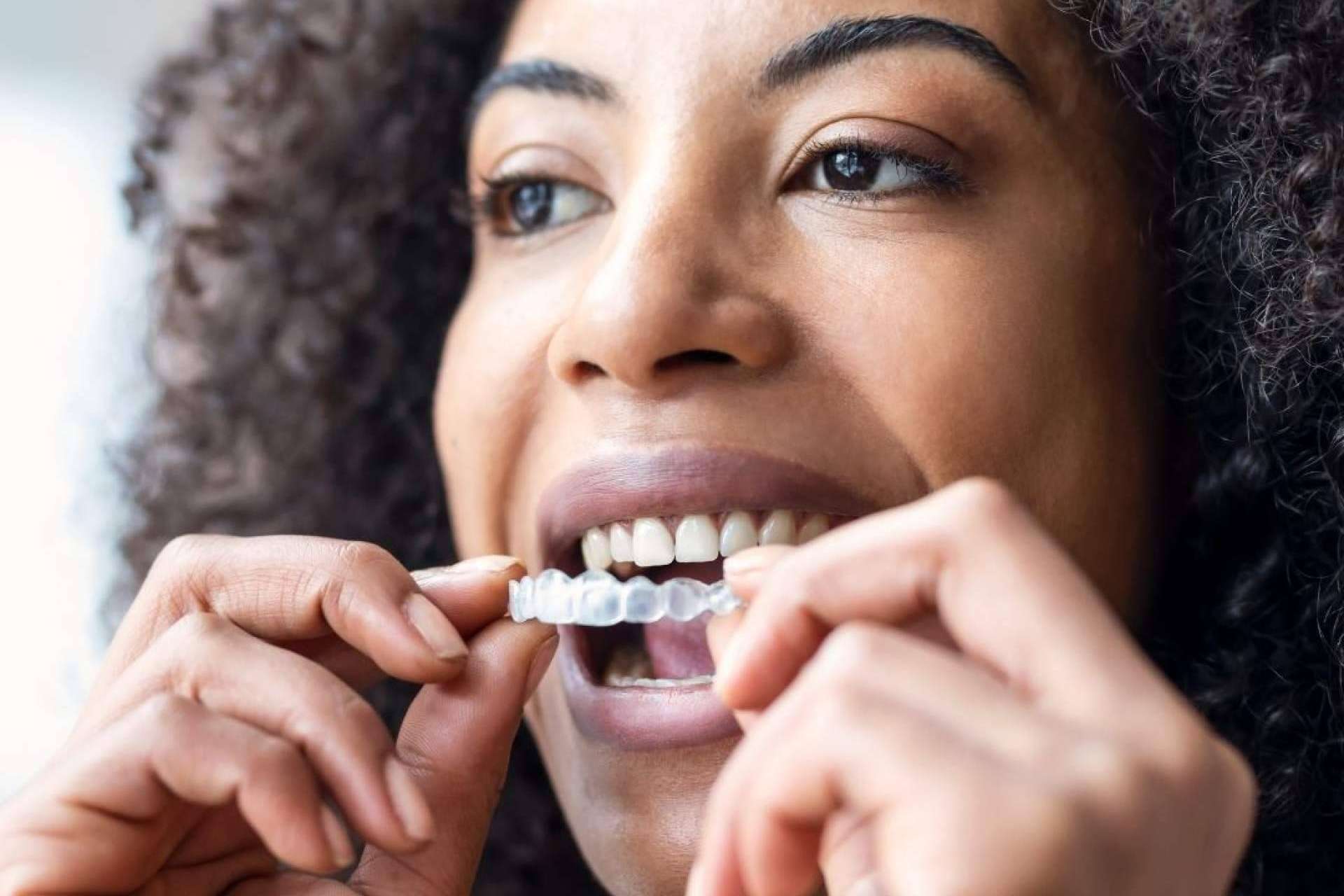 Custom Dental presenta la ortodoncia invisible como la opción innovadora para una sonrisa perfecta