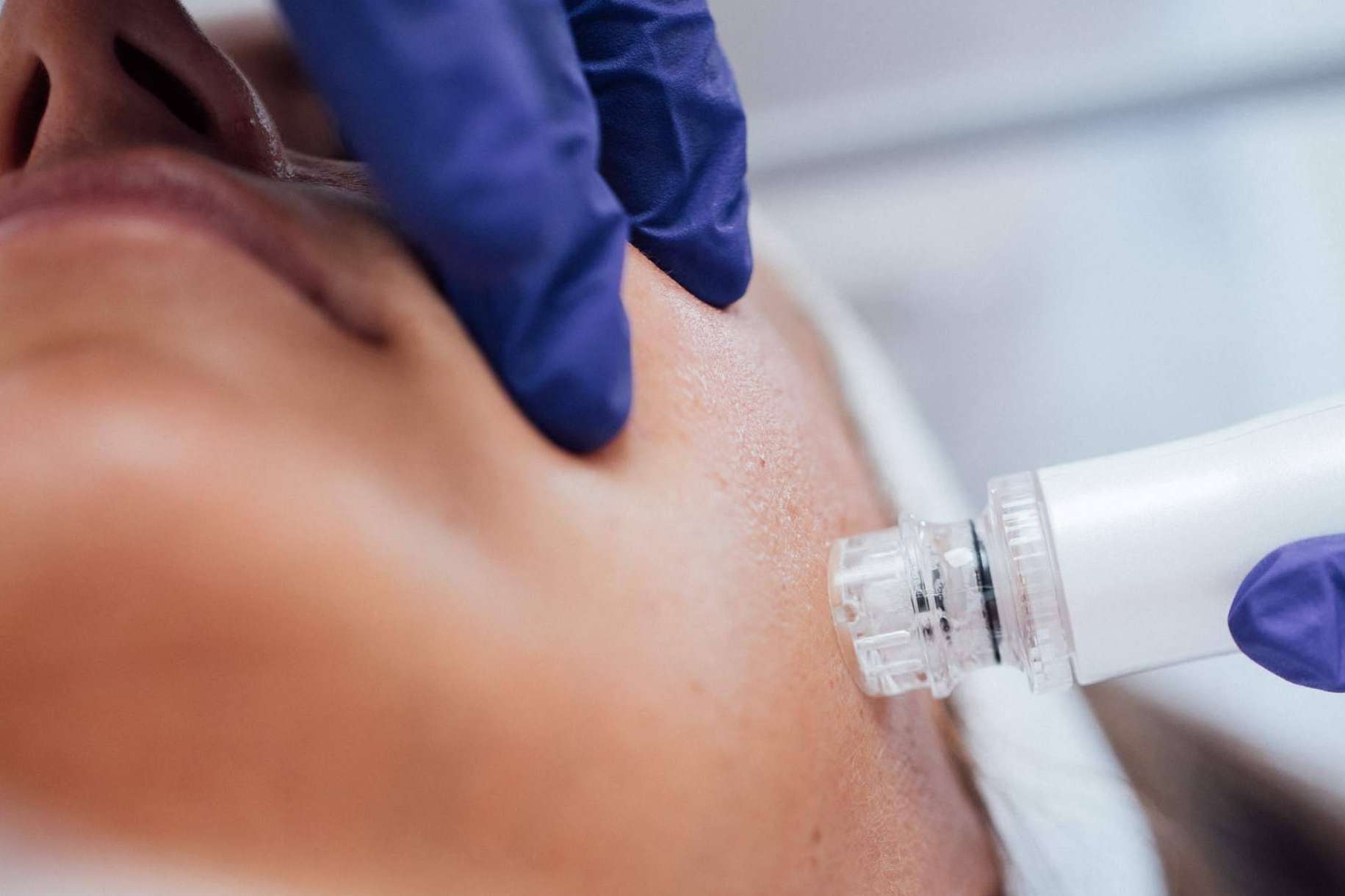 El tratamiento facial en Mallorca que cambiará la piel; Indiba Ona en Dermativa