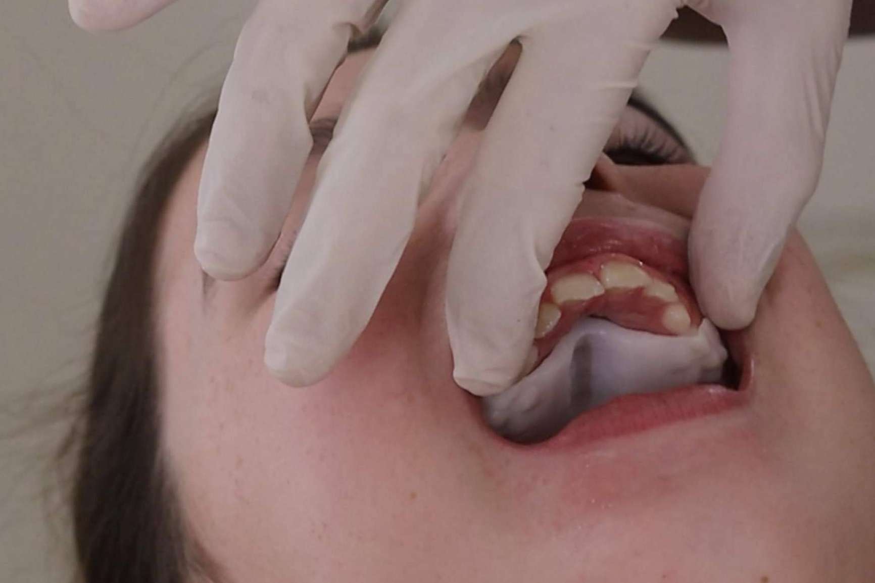 The groundbreaking Invisalign Palatal Expander, a tool that is transforming maxillary expansion treatment