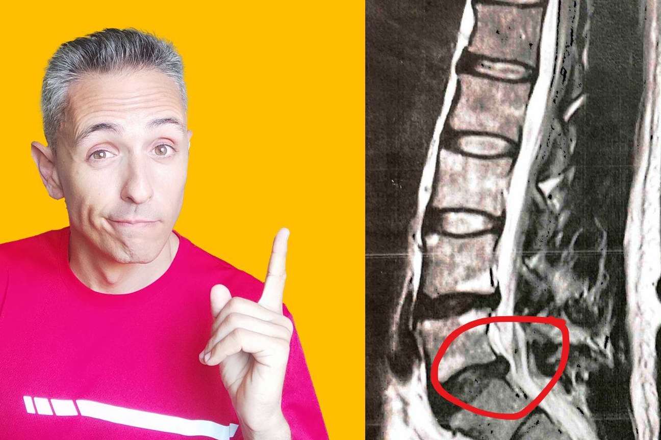 El método de Roberto Galván para ganar la batalla a las molestias derivadas de la hernia discal L5-S1