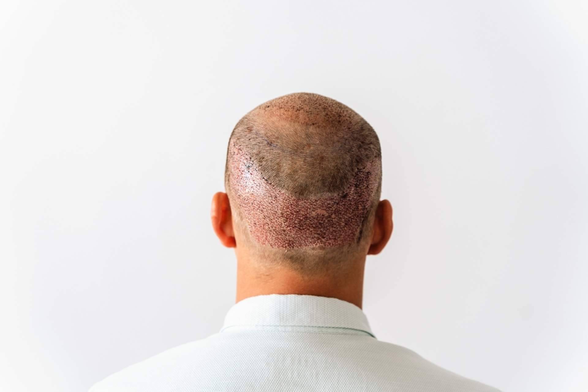 Técnica FUE Zafiro HD y mesoterapia regenerativa; la fórmula del Dr. Mora para un trasplante capilar óptimo