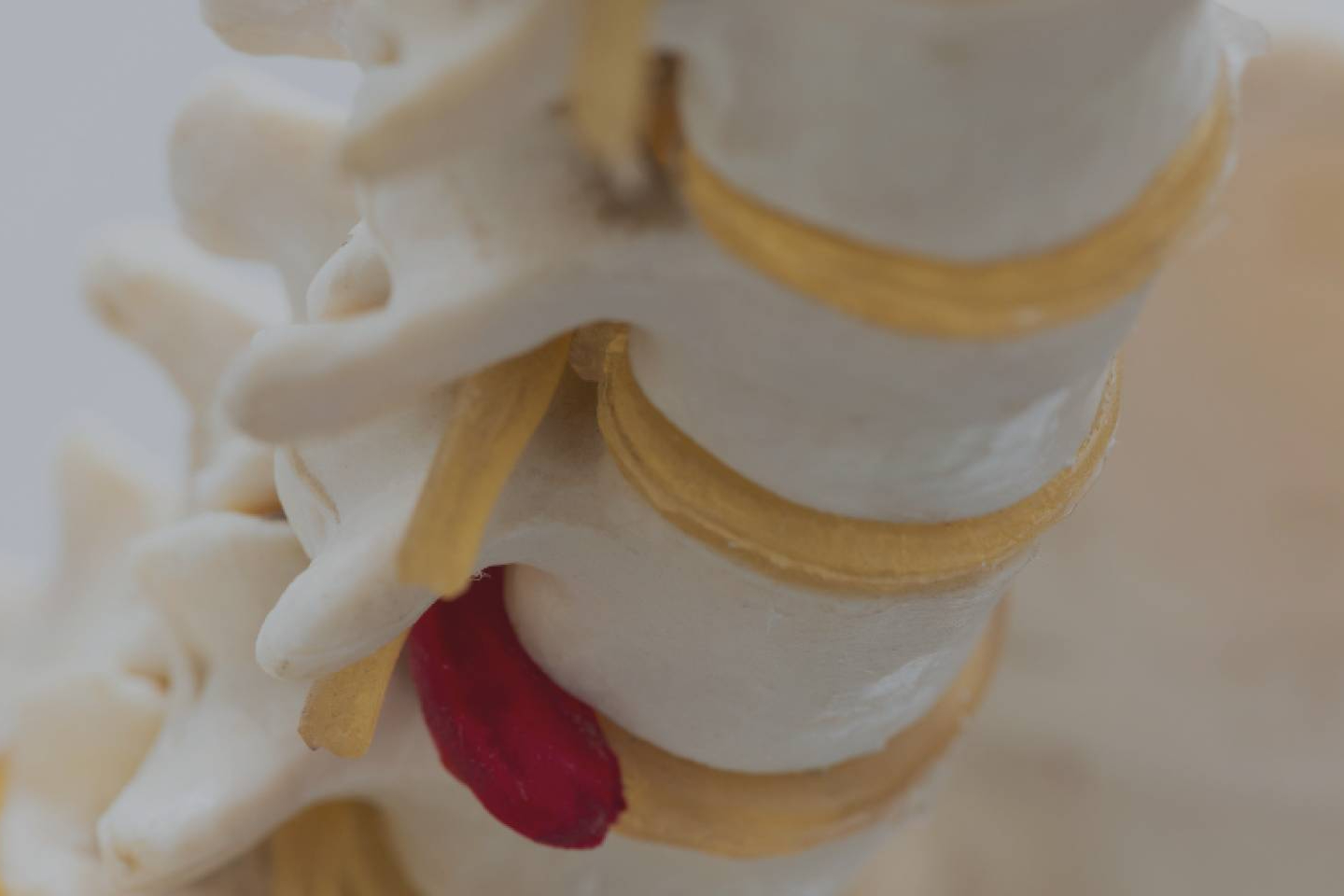 Como la fisioterapia avanzada ayuda a evitar la cirugía en hernias discales
